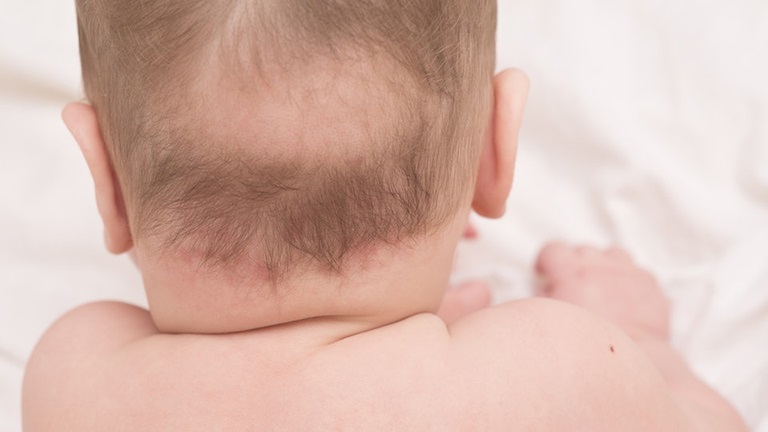 Nguyên nhân xảy ra tình trạng rụng tóc ở trẻ nhỏ