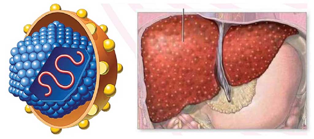 Những triệu chứng và tiến triển của bệnh viêm gan siêu vi B